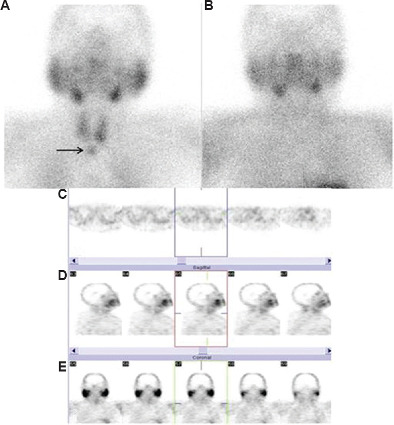 Early (A) and late (B) planar views of dual-phase technetium 99m methoxyisobutylisonitrile parathyroid scintigraphy. A parathyroid lesion, which later confirmed as parathyroid adenoma, showed rapid radiopharmaceutical washout. Early planar view showed the lesion (A, arrow). Transaxial (C), sagittal (D) and coronal (E) slices of single photon emission computed tomography study (with 64×64 matrix) which was reconstructed with iterative reconstruction algorithm. The focus was detectable neither on late planar view nor on single photon emission computed tomography study with both reconstruction algorithms (patient no: 42, Table I).