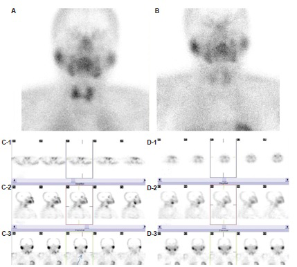 Early (A) and late (B) planar views oftechnetium-99m methoxyisobutylisonitrile parathyroid scintigraphy. Transaxial (C-1), sagittal (C-2) and coronal (C-3) slices of technetium-99m methoxyisobutylisonitrile single-photon emission computed tomography study which was acquired in 128×128 matrix were generated using iterative reconstruction algorithm. Parathyroid pathology was depicted in the upper pole of left thyroid lobe (C-3, arrow). However, the focus was not detectable on images analyzed with filtered backprojection algorithm, transaxial (D-1), sagittal (D-2) and coronal (D-3) views (patient no: 18, Table I).