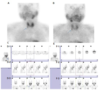 A focus of increased activity was observed on early (A) and late (B) planar views (A-B, arrows). Three-dimensional image of single photon emission computed tomography study with iterative reconstruction (C-arrow), clearly depicted parathyroid lesion. Transaxial (D-1), sagittal (D-2) and coronal (D-3) slices of technetium-99m methoxyisobutylisonitrile single photon emission computed tomography study, faintly demonstrated the radioactivity retention in the lower part of right thyroid lobe (D-3, arrow). Delineation of hyperplastic parathyroid tissue could not be possible either on three-dimensional (E) or on transaxial (F-1), sagittal (F-2) and coronal (F-3) views of single photon emission computed tomography study with filtered backprojection, (patient no: 27, Table I).