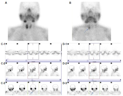Early (A) and late (B) planar views. Single photon emission computed tomography study was performed using with 64×64 matrix. Transaxial (C-1), sagittal (C-2) and coronal (C-3) slices of technetium-99m methoxyisobutylisonitrile single photon emission computed tomography study which were reconstructed using with iterative reconstruction. A parathyroid lesion was delineated in the lower pole of right thyroid lobe (C-3, arrow). The same parathyroid lesion could also be depicted in the lower pole of right thyroid lobe with filtered backprojection algorithm (D-3, arrow). However, streak artefacts were present on transaxial slices (D-1), and image degradation was observed compared to iterative reconstruction algorithm (patient no: 22, Table I).