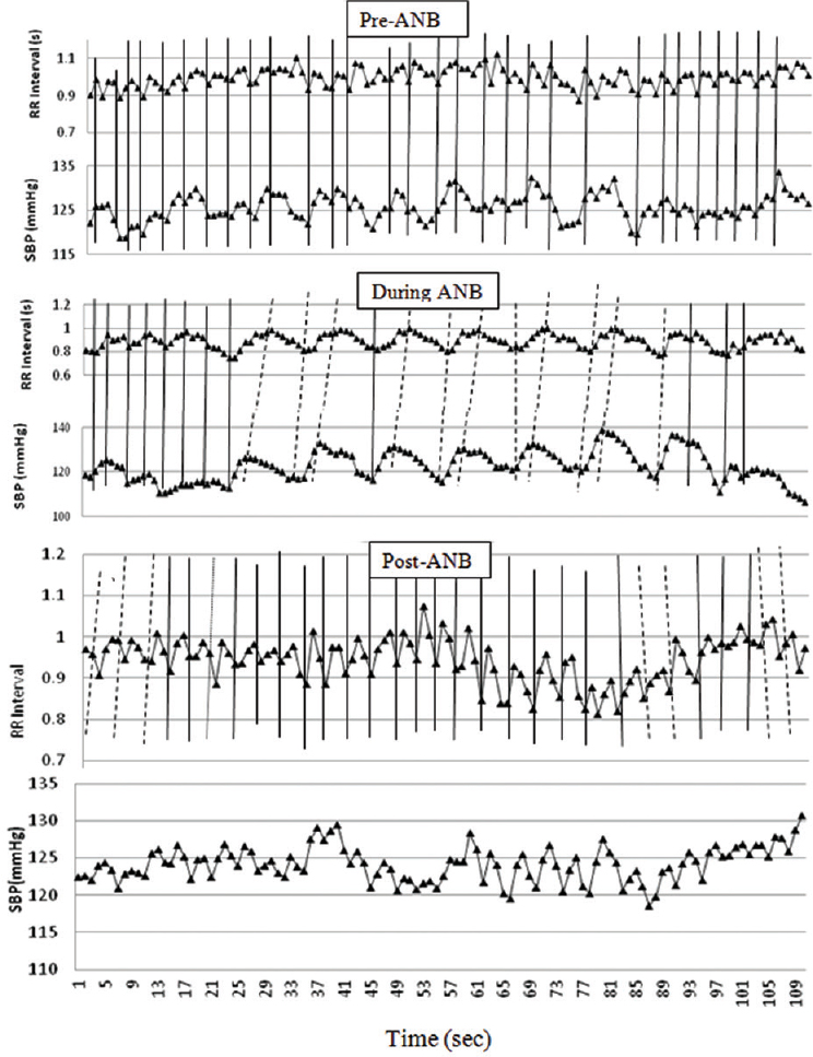 RR interval and systolic blood pressure plotted in time series for pre-, during- and post-alternate nostril breathing (ANB). Based on the sign changes in RR interval, vertical bars (continuous) have been plotted to depict time correspondence of RR interval and systolic blood pressure. Solid vertical bars indicate that both events are happening simultaneously without any phase lag. Dotted vertical bars indicate the phase lag between RR interval and systolic blood pressure. Simultaneous rise and fall of blood pressure and RR interval and 0° phase relationship were evident in pre- and post-ANB and in the initial part of during-ANB. Systolic blood pressure preceded changes in RR interval during-ANB, indicating alteration in phasic relationship, which lasted little over in post-ANB.