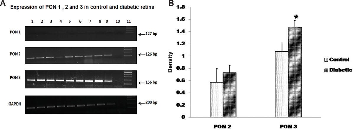 The mRNA expression of all the PON genes were analysed in the control and the donor retina from diabetic patients. (A) There was very negligible expression of PON1 in both the condition, and not much change in the PON2 expression but there was significant increase in the PON3 expression in diabetic retina compared to control retina. Lanes 1-6, control retina; lanes 7-9, diabetic retina; lane 10, NC; lane 11, DNA ladder. (B) Quantification using image J showed a significant (P<0.05) increase in PON3 expression in diabetic retina compared to control.