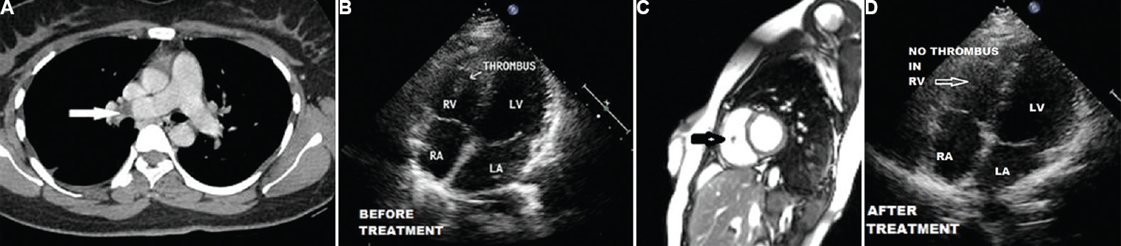 (A) Computed tomography pulmonary angiogram showing a filling defect (arrow) in the distal right pulmonary artery. (B) Transthoracic echocardiogram showing a thrombus (arrow) in the right ventricle. (C) Cardiac magnetic resonance image showing a stalk-free mass suggestive of thrombus in the right ventricle (arrow). (D) Transthoracic echocardiogram, three-week post-treatment, showing complete resolution of the right ventricular thrombus. RV & LV, right and left ventricle; RA & LA, right and left atrium.