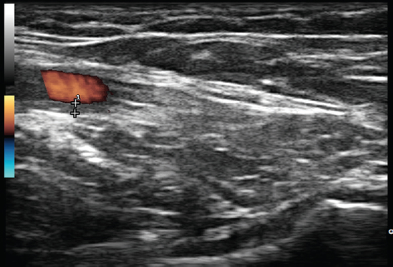 Ultrasound examination of glenohumeral joint from axillary approach revealing no significant effusion inside a joint capsule (bottom of the picture). With the same approach, axillary artery is simultaneously examined with colour duplex ultrasound (left, upper side of the picture): it reveals homogenous, hypoechoic vessel wall thickening of 1 mm (indicated between “+” signs), well delineated towards the luminal side being consistent with axillary arteritis.