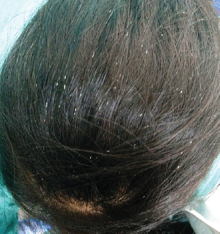 Naked eye examination showing peripilar keratin cysts as multiple discrete firm, shiny, 2-7 mm long, white tubular accretions encircling hair on vertex/frontal scalp at variable lengths from the scalp.