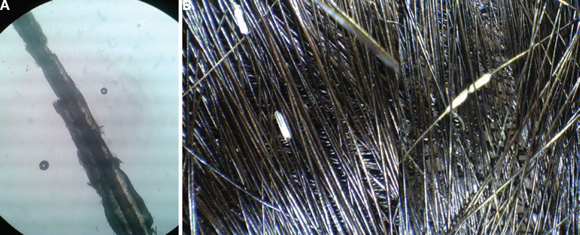 (A) Peripilar keratin cysts as seen under light microscopy in saline mount. These can be missed in KOH mount as these are dissolved (B) Amorphous whitish tubular structure of peripilar keratin cysts of variable lengths encircling the hair shaft on dermoscopy.