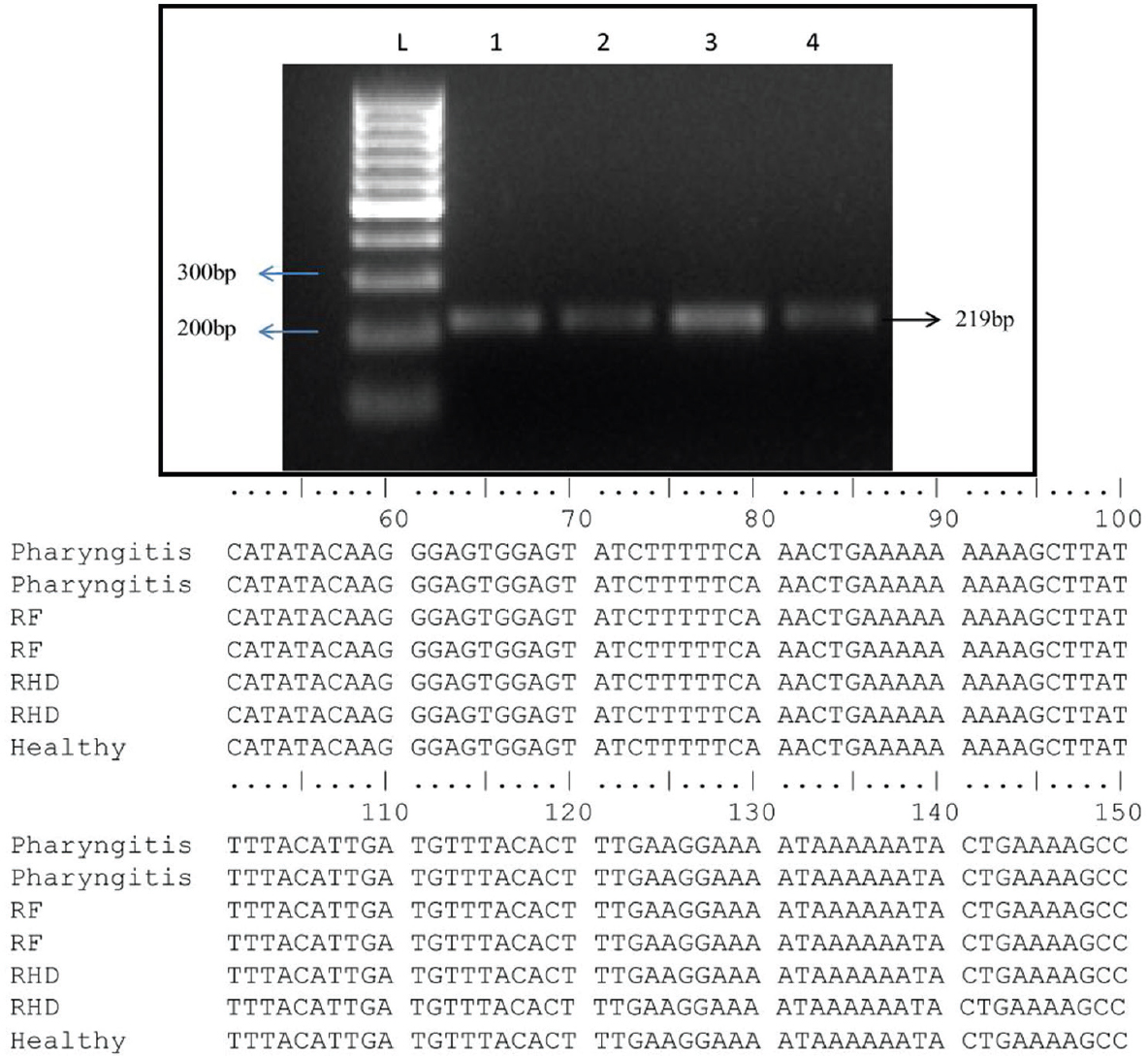Amplified polymerase chain reaction (PCR) product along with multiple alignments of exon 3 of mannose-binding lectin 2 (MBL2) gene sequences. Representative gel picture showing 219bp amplified PCR product of exon 3 of MBL2. Lane-1, healthy control; Lane-2, pharyngitis; Lane-3, rheumatic fever; Lane-4, rheumatic heart disease patient DNA; Lane L: 100 bp ladder. The aligned sequences represent no SNPs in exon 3 of MBL2.