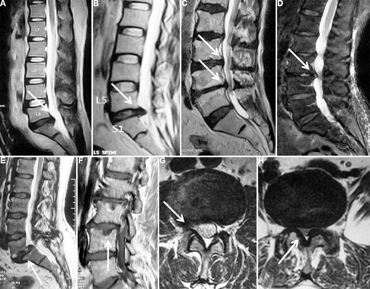 (A) T2W sagittal section shows L5-S1 disc bulge (arrow), (B) T2W axial section shows L5-S1 level disc extrusion (arrow), (C) T2W axial section shows narrowing of spinal canal at multiple levels (arrow), (D) T2W sagittal section shows L3-L4 disc protrusion and high intensity zone (arrow), (E) T2W sagittal section shows L5-S1 listhesis (arrow), (F) T1W sagittal section shows Schmrol nodule at L3-L4 (arrow), (G) T2W sagittal section shows right nerve root compression at L3-L4 level (arrow), (H) T2W axial section shows L4-L5 ligamentum flavum hypertrophy and facet joint arthropathy (arrow).
