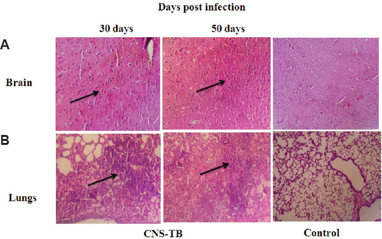Representative photomicrographs of histopathological examination of (A) brain and (B) lungs section (5 μm) of control and CNS-TB mice stained with haematoxylin and eosin. Mice were sacrificed 30 and 50 days after intravenous infection with Mycobacterium tuberculosis C3 strain. Organs (n=4) were used for histological examination. Gross pathological examination of brain sections of CNS-TB mice showed lymphocytic proliferation (arrows) with development of oedema of brain parenchyma which was more prominent at 50 days post-infection. Analysis of lung section at 30 days revealed high lymphocytic infiltarion, with alveolar space mostly filled with inflammatory cells (arrows) and oedematous fluid. This gross lung pathology was considerably less on examination at 50 days post-infection (×100).