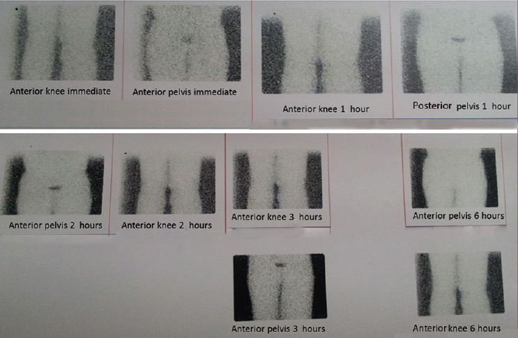 Lymphoscintigraphy of the lower limbs. Uptake was not seen in lymphatic pathways, pelvic and popliteal lymph nodes. There is complete occlusion of lymphatic channels.