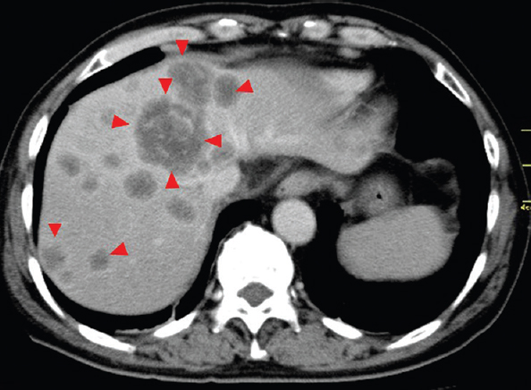 Computed tomography scan showing multiple liver tumours in both lobes before the initiation of chemoimmunotherapy (arrow heads).