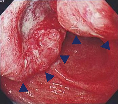 Gastrointestinal videoendoscopy showing round wall with central ulceration in the antrum of the stomach (arrow heads) on admission. The histological diagnosis of biopsied samples was well-differentiated adenocarcinoma.