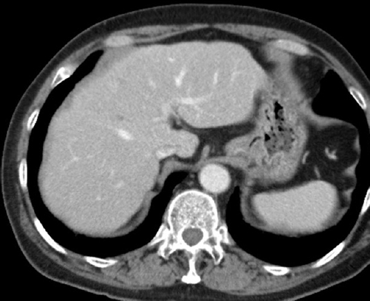 Computed tomography scan demonstrating complete disappearance of metastatic liver tumours after chemoimmunotherapy.