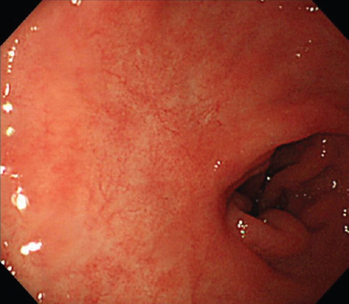 Gastrointestinal videoendoscopy showing complete resolution of the primary gastric lesions after chemoimmunotherapy.