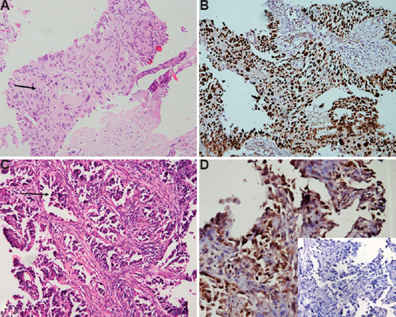 (A) Morphologically differentiated squamous cell carcinomas with intercellular bridges and intracellular keratinization (arrow) (H & E, ×400). (B) p40 immunostain shows strong (3+) and diffuse nuclear positivity. (C) A case of squamous cell carcinomas with pseudoglandular pattern and acantholysis (arrow) (H & E, ×400). (D) p40 shows nuclear positivity. Inset shows negative TTF-1 stain.