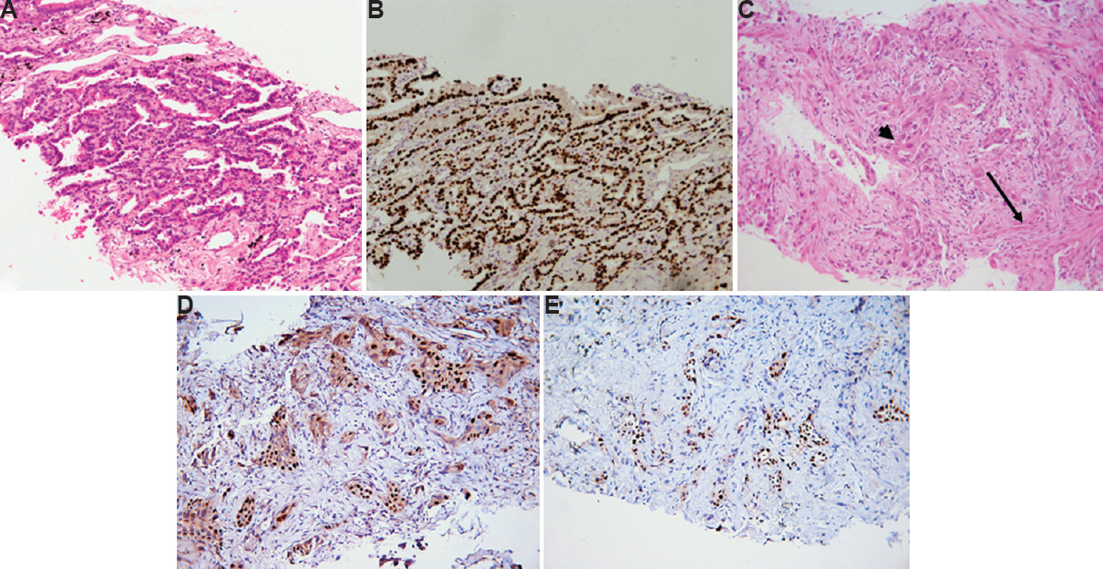 (A) Morphologically differentiated adenocarcinomas with lepidic histologic pattern (H & E, ×400). (B) Thyroid transcription factor-1 immunostain shows strong (3+) and diffuse nuclear positivity. (C) Adenosquamous carcinoma with glandular (arrow) and squamous differentiation (arrowhead) (H & E, ×400). (D) p40 and (E) thyroid transcription factor-1 show nuclear positivity in different cell populations of adenosquamous carcinoma.