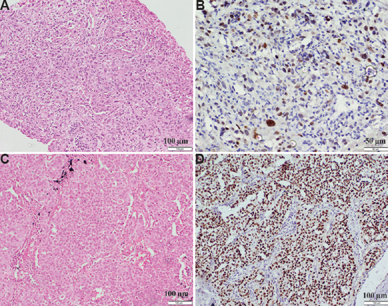 (A) NSCLC-not otherwise specified without clear-cut morphologic differentiation (H & E, ×400). (B) p40 shows nuclear positivity in the same case indicating squamous lineage. (C) Another case of NSCLC not otherwise specified on morphology which is arranged in solid islands (H & E, ×400). (D) thyroid transcription factor-1 shows diffuse nuclear positivity suggesting diagnosis of adenocarcinoma.