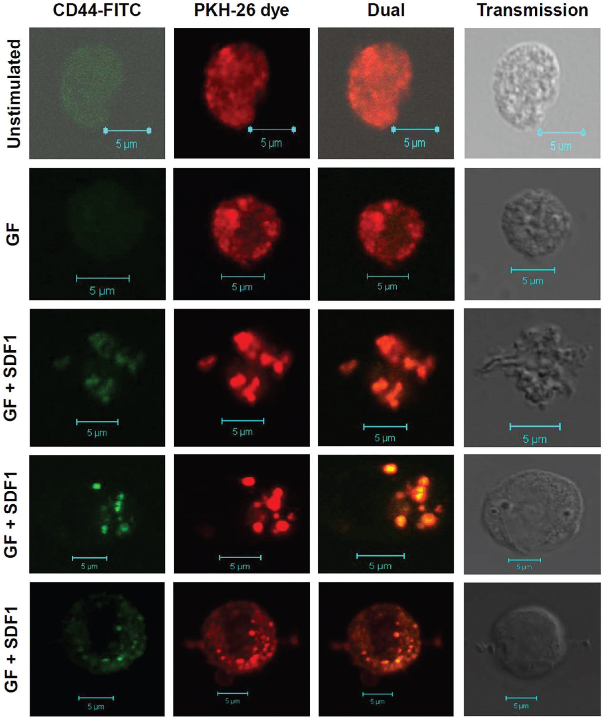 Colocalization of lipid grafts and CD44 in stromal cell-derived factor 1-CXCR4 signalling in haematopoietic stem and progenitor cells (HSPC). Ex vivo expanded cells were labelled with PKH-26 lipid dye. Later, these were stained with fluorescein-isothiocyanate-conjugated antibody against CD44 and analyzed by laser confocal microscopy. CD44 is colocalized in lipid rafts and is evenly distributed in unstimulated HSPC and GF HSPC. CD44 gets aggregated in lipid rafts upon stromal cell-derived factor 1 (SDF1) stimulation. Upon SDF1, stimulation cells become chemotactic and acquire migratory phenotype.