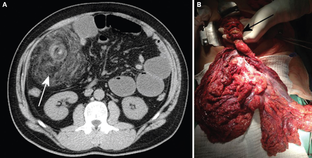 (A) Abdominal CT scan showing concentric mesenterial fat stranding at the right abdominal cavity (white arrow). (B) Operative picture demonstrating torsioned and necrotic omentum that was twisted several times around its long axis (black arrow).