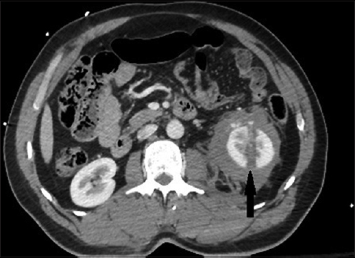 Computed tomography image of the left kidney after the shotgun injury. Arrow shows the avulsion.