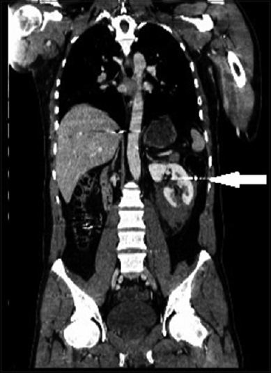 The coronal images of the kidney. Arrow shows the bullet.