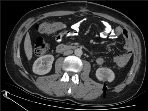 Computed tomography image of the injured kidney (arrow) after one month from the trauma.