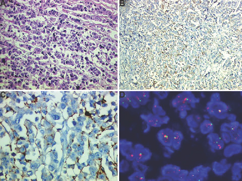 A patient affected by gap in biomarker testing (A) haematoxylin and eosin section confirmed that tumour was poorly fixed (H & E: 200×) (B) weak HER2neu staining due to poor fixation (immunoperoxidase: 200×), (C) higher power to indicate that HER2neu would be interpreted as score 1+/negative (immunoperoxidase: 400×), and (D) tumour as tested by fluorescent in situ hybridization found to be HER2neu amplified (Oil).