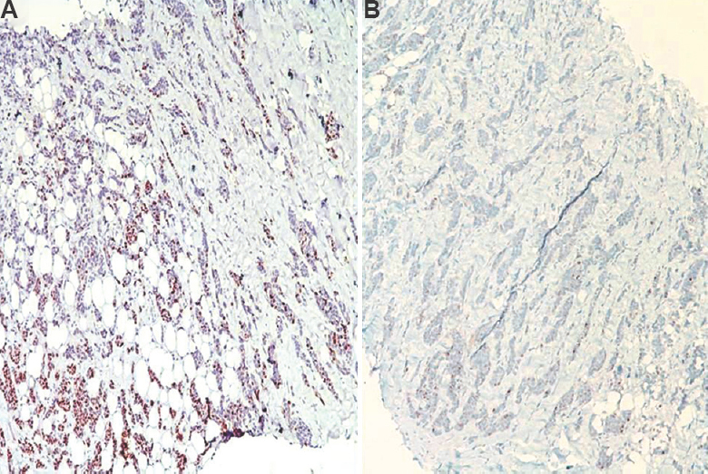 Same tumour stained using two protocols (A) manual staining gave a strong progesterone receptor staining (equal to Allred score 8/8), and (B) progesterone receptor testing in an automated stainer with same antibody gave weaker results (immunoperoxidase: 100×).