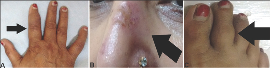 (A) Photograph of the hand showing dactylitis of the right index finger (black arrow). (B) Violaceous indurated plaque on the bridge of nose (black arrow). (C) Dactylitis of the right second toe (black arrow).