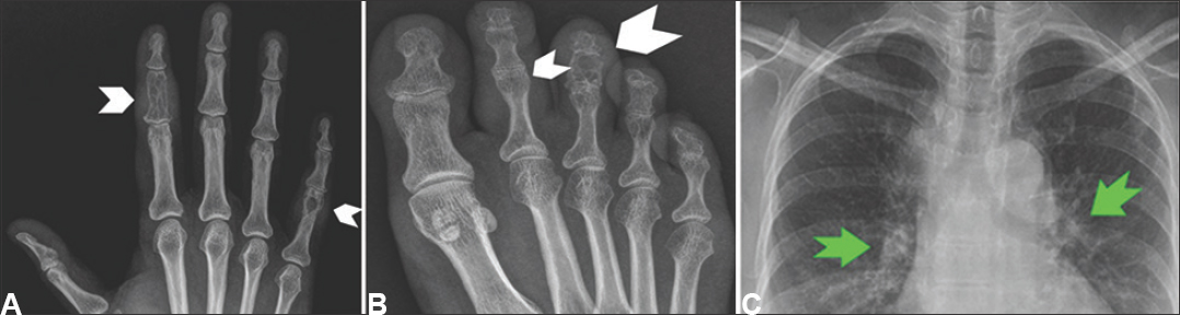 (A) X-ray of the right hand showing osteolytic lesions in the involved phalanges with a reticular pattern (white arrowheads). (B) X-ray of the right foot showing osteolytic lesions in the involved phalanges (white arrowheads). (C) X-ray chest with bilateral hilar lymph node enlargement (green arrows).