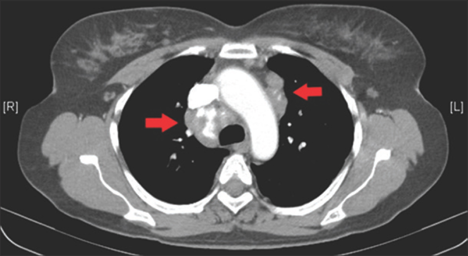 Computed tomography scan of the thorax showing bilateral mediastinal lymphadenopathy (red arrows), including calcified lymph nodes on the right.