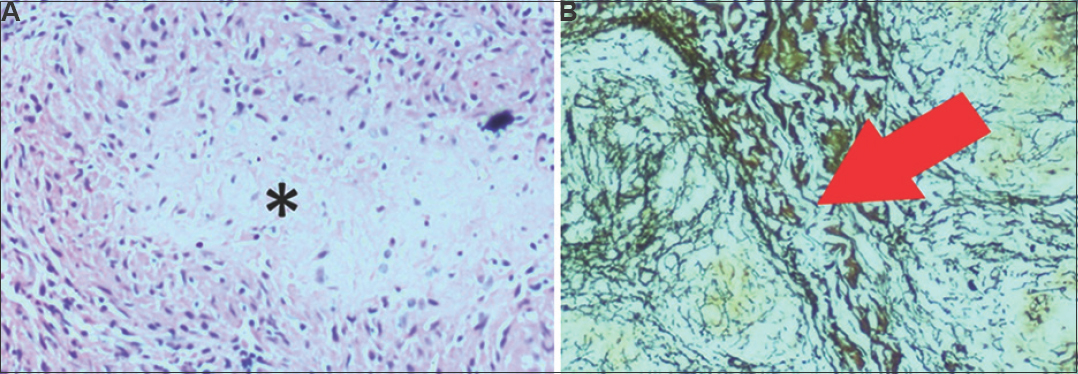 (A) Bone biopsy demonstrating granulomas, marked asterisk (*) (H & E, ×20). (B) Skin biopsy demonstrating non-necrotizing granulomas (red arrow) reticulin stain, ×10.