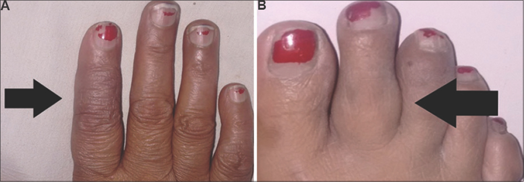 (A) Hand lesion demonstrating partial resolution after 4 days of therapy (black arrow). (B) Right foot lesion demonstrating partial resolution after 4 days of therapy (black arrow).