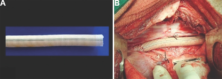 (A) Hydrogel sealed fluoropassivated woven polyester vascular prosthesis (test graft) - 10 mm internal diameter. (B) Intraoperative photograph showing interposition test graft in thoracic aortic position in pig using left posterolateral thoracotomy under general anaesthesia.