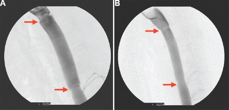 (A) Check digital subtraction angiogram showing intact proximal and distal anastomoses (red arrows), normal graft flow including the well-visualized crimping on the graft. (B) Digital subtraction angiogram at 26 wk after implantation of hydrogel sealed test graft showing excellent functional status before explantation after euthanizing the animal under general anaesthesia.