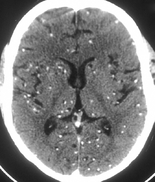 Contrast-enhanced computed tomography (CECT) brain showing innumerable hyperdensities with eccentric calcific foci in both cerebral hemispheres - 'starry sky’ appearance.