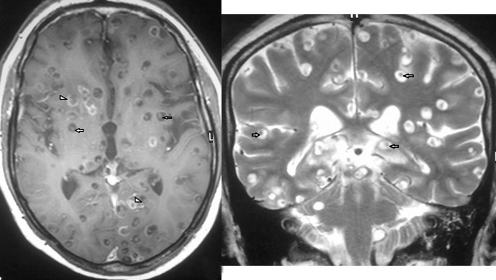 (Left panel) Magnetic resonance imaging (MRI) brain T1-weighted sequence showing multiple hypointense cystic lesions, some with eccentric peripheral enhancement (arrowheads) and some with intracystic nodules suggestive of scolex (arrows). The head of the larva in the cyst gives the lesion a pathognomonic ‘hole-with-dot’ appearance. (Right panel) MRI brain T2-weighted sequence showing multiple hyperintense cystic lesions with intracystic hypointensity suggestive of scolex (arrows).