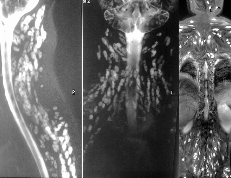 (Left and middle panels) Magnetic resonance imaging (MRI) spine shows diffuse large ovoid cystic lesions in paraspinal region. (Right panel) MRI spine shows generalized uptake in all muscles including masticator (arrow) and tongue muscles (arrowhead).