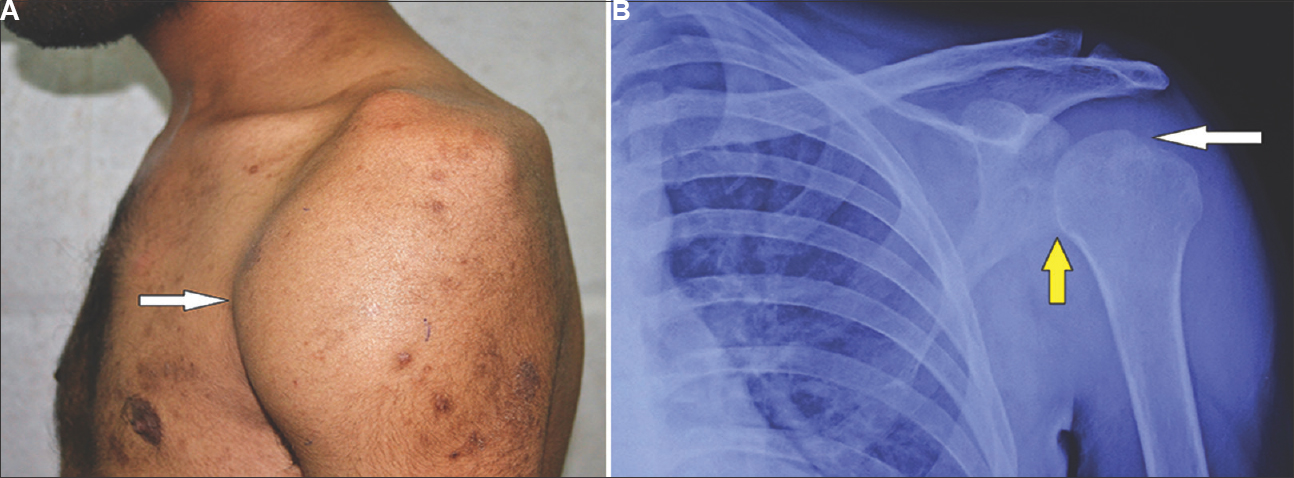 (A) Clinical photograph of the patient depicting soft-tissue swelling on the anterior aspect of the shoulder with significant wasting of muscles around the shoulder (arrow). (B) Anteroposterior radiograph of the shoulder showing the Phemister's triad - lytic lesion of the greater tuberosity (white arrow), diffuse periarticular osteopenia and joint space reduction (yellow arrow).