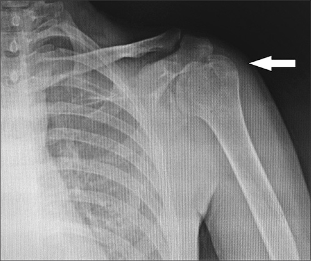 Post-treatment anteroposterior radiograph of the shoulder with improved osteopenia and reduction of the soft-tissue shadow around the shoulder as compared to the original radiograph (arrow).