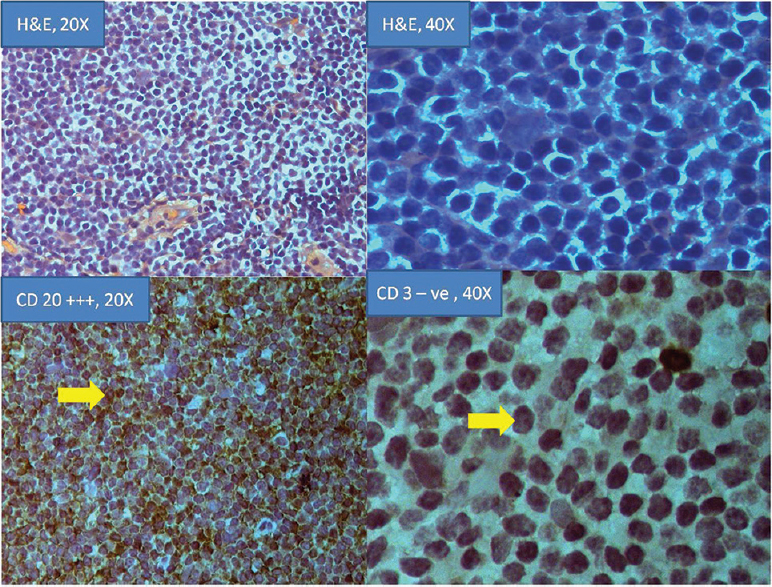 Hematoxylin and eosin, (×20 and ×40) and immunohistochemistry of non-Hodgkin lymphomas of orbit with CD 20 (×20) and CD 3 (×40) immunostains.