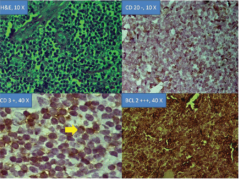 Hematoxylin and eosin, (×10) and immunohistochemistry of T-cell non-Hodgkin lymphomas of orbit with CD 20 –(×10), CD 3 + (×40) and B-cell lymphoma +++ (×40).
