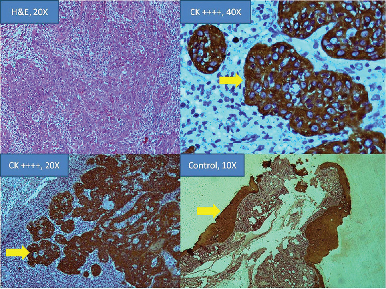 Hematoxylin and eosin, (×20) and immunohistochemistry for cytokeratin (ck) positivity (×40 and ×20) in a squamous cell carcinoma of conjunctiva. Positive control (×10) shown.