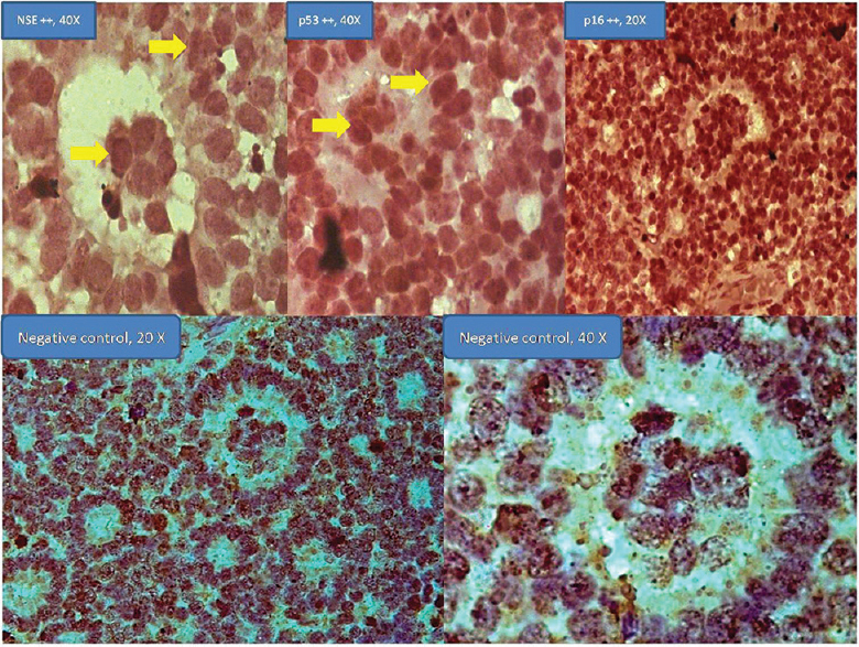 Immunohistochemistry for neuron-specific enolase (×40), p53 (×40), and p16 (×20) shown in new rosettes retinoblastoma. Negative controls (×20 and ×40).
