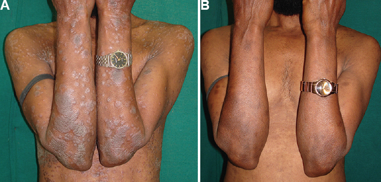 (A) Patient with psoriasis area severity index (PASI) of 7.5 randomized to Unani group at baseline, (B) Response to Unani treatment at 12 wk.