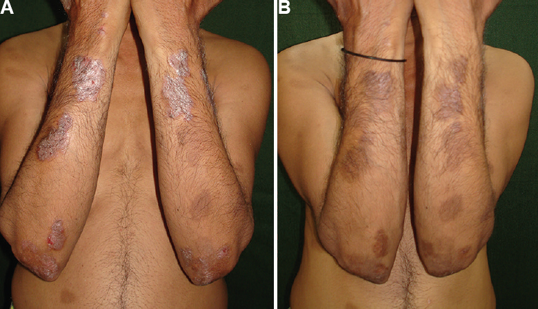 (A) Patient with psoriasis area severity index (PASI) of 10.3 randomized to psoralen plus ultraviolet A sol group at baseline, (B) Response to psoralen plus ultraviolet A sol treatment at 12 wk.
