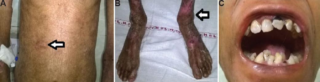 (A) Photograph showing extensive generalized scarring with focal areas of hypopigmentation on abdomen (arrow). (B) Raw erosions, haemorrhagic encrustation and scarring in both legs (arrow). (C) Dental caries with enamel defect and irregular dentition with gingival oedema.