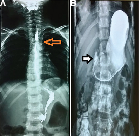 (A) Oral contrast study showing persistent narrowing at cricopharyngeus (arrow). (B) Oral contrast study showing delayed gastric emptying at eight hours (arrow).