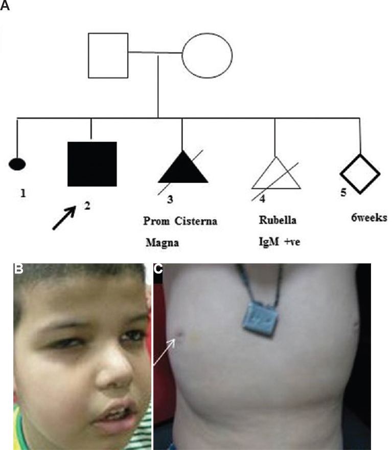 (A) The pedigree with a medical termination of pregnancies (II-3 and II-4) in view of prominent cisterna magna. (B) The facial coarseness, slightly deep set eyes, round nasal tip, full cheeks and thick lips. (C) Inverted nipples (arrow).