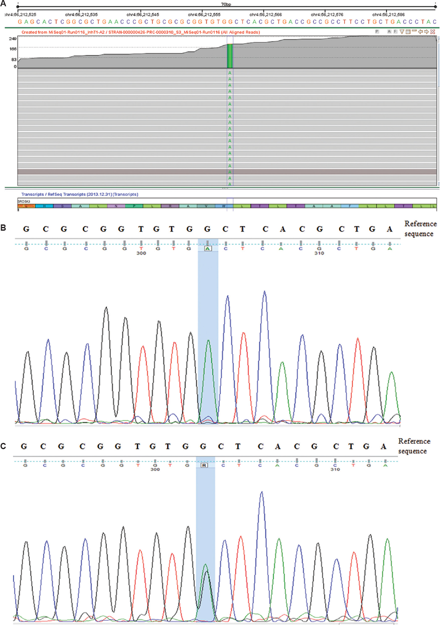 (A) Genome browser view in Strand NGS showing the homozygous change c.57G<A (p.Trp19Ter) in the SRD5A3 gene. (B) Sanger sequencing data from the proband showing the homozygous nucleotide change ‘G<A’ (c.57G<A) in the SRD5A3 gene. (C) Sanger sequencing data from the parents and the foetus showing the heterozygous nucleotide change ‘G<A’ (c.57G<A) in the SRD5A3 gene, suggesting their carrier status.